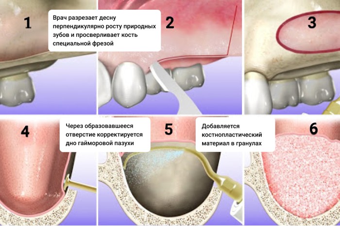 Закрытый синус лифтинг Синус лифтинг фото